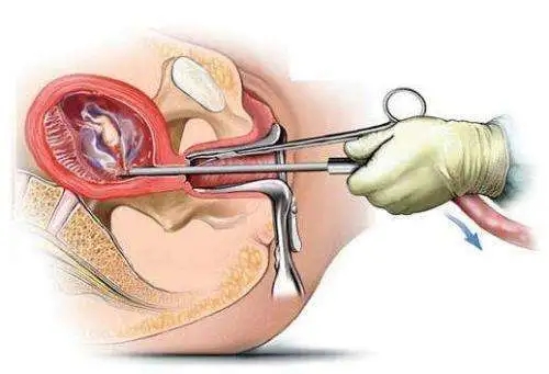 做多次无痛人流的危害到底有多大