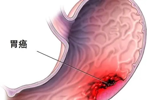 胃癌前期五个身体信号是什么