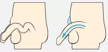 勃起角影响性生活质量？3种原因造成角度小！